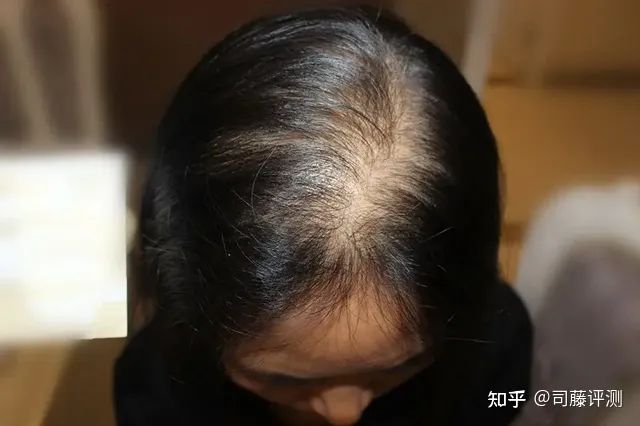 女性脱发严重是什么原因引起的？了解这几点可让头发健康生长