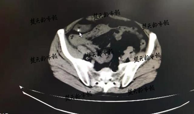 听信偏方生吞活泥鳅，六旬男子养生不成引发肠穿孔中国青年网2019-08-27 07:38中国青年网2019-08-27 07:38